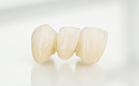 オールセラミック