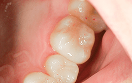 ケース1の治療後