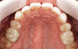 ケース3の治療後