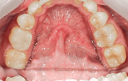 ケース4の治療後