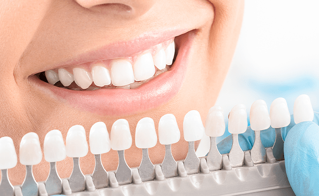 ラミネートベニア