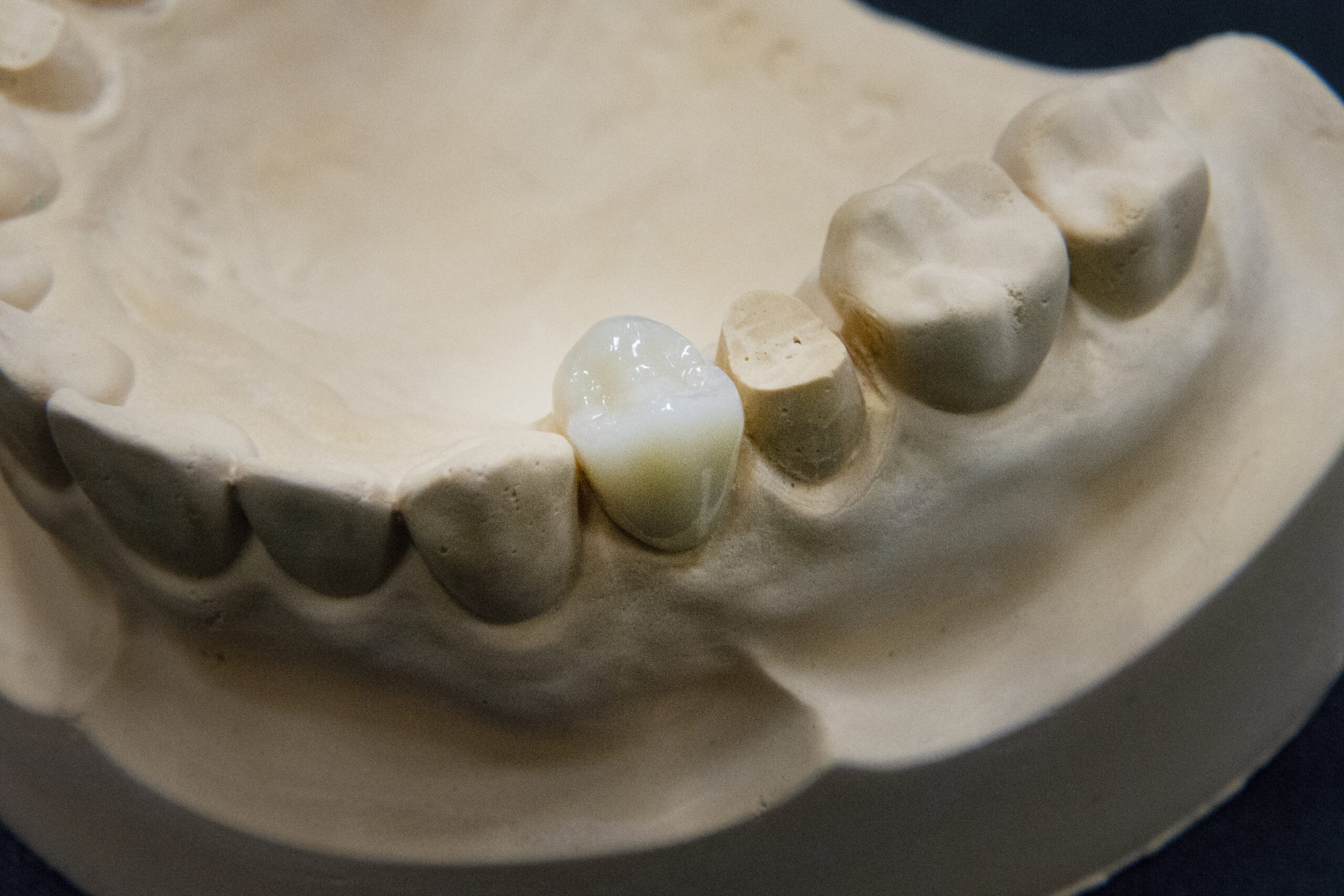 ハイブリッドセラミックインレー