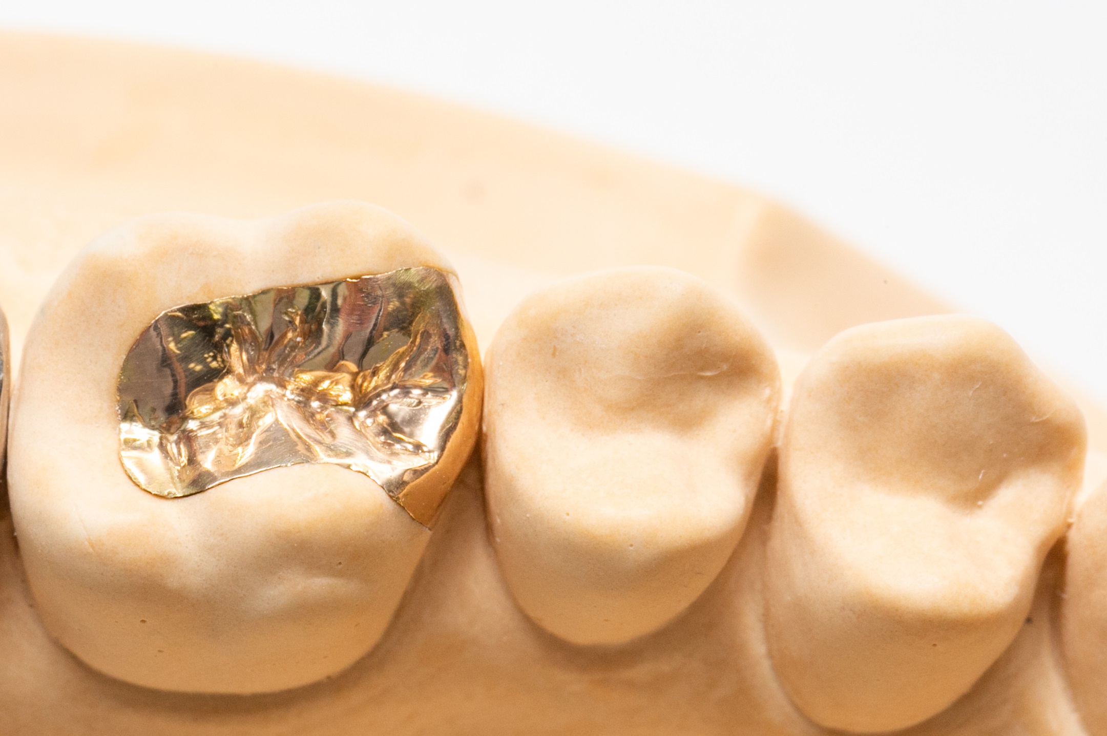 ゴールドインレー