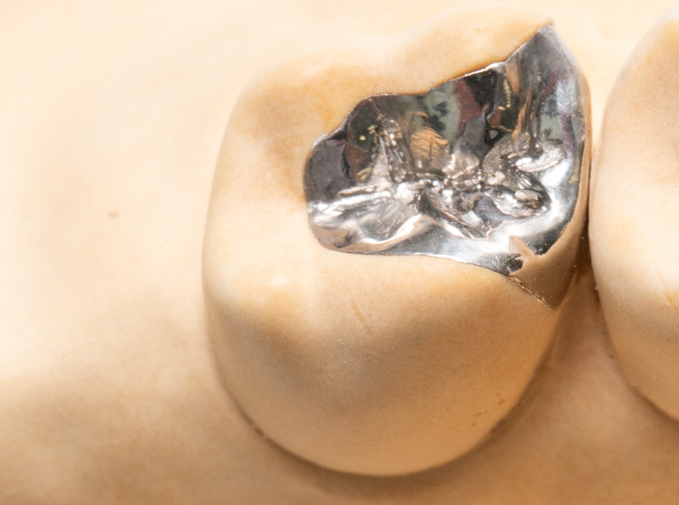 銀歯（金銀パラジウム合金）インレー