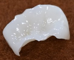 ハイブリッドセラミックインレー