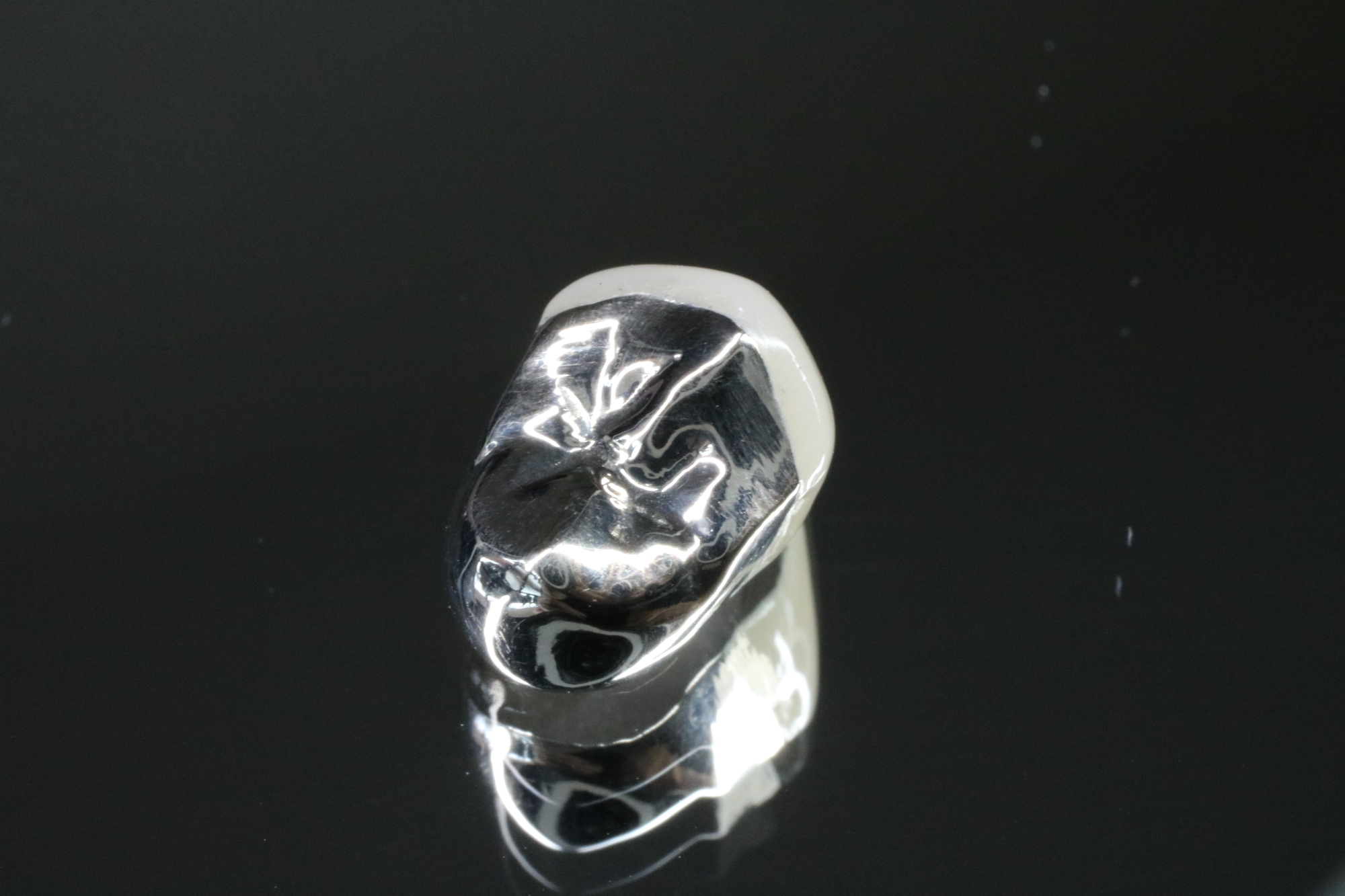 銀歯（金銀パラジウム合金）クラウン