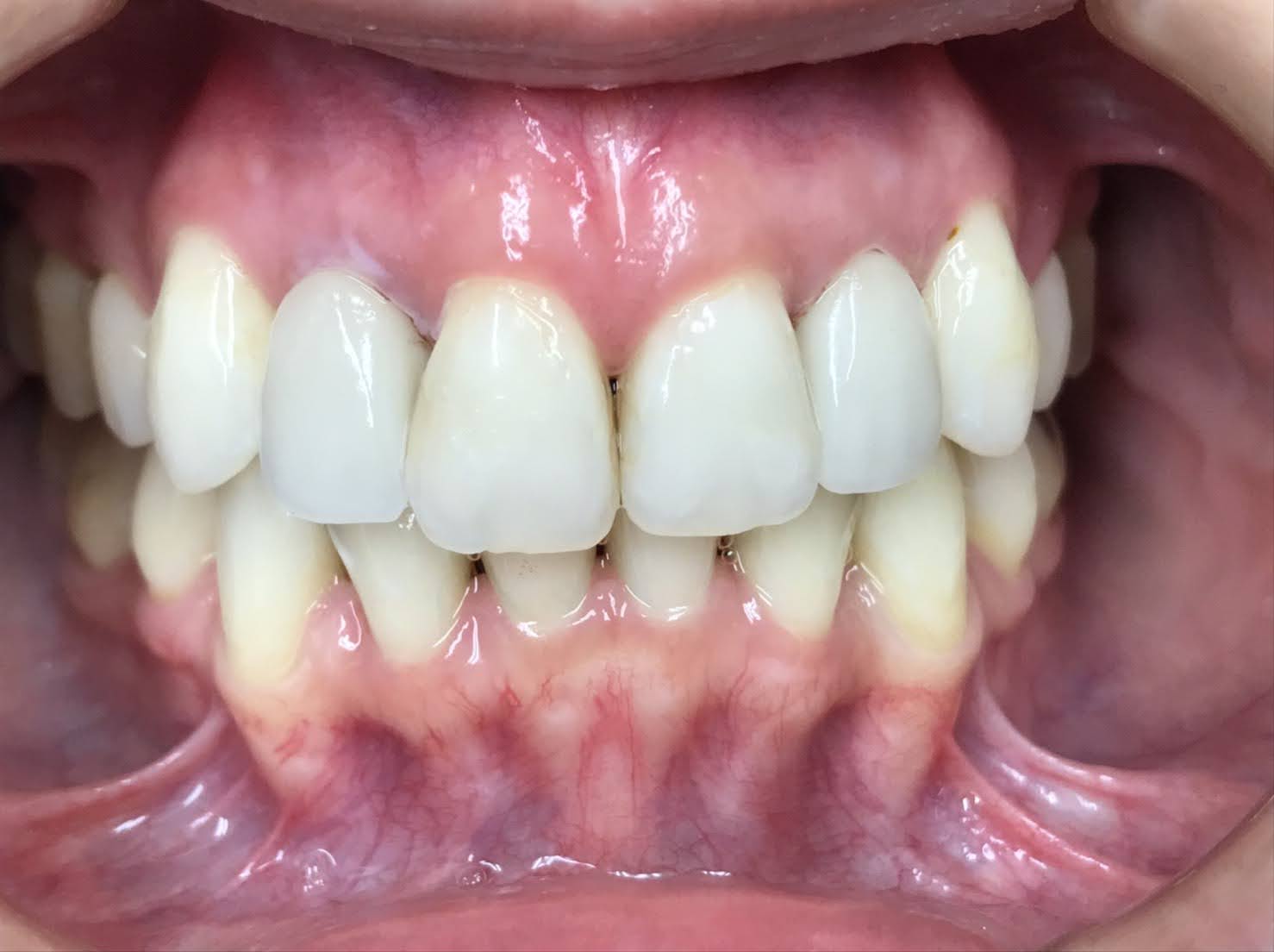 症例１４ セラミッククラウン（2本）施術後