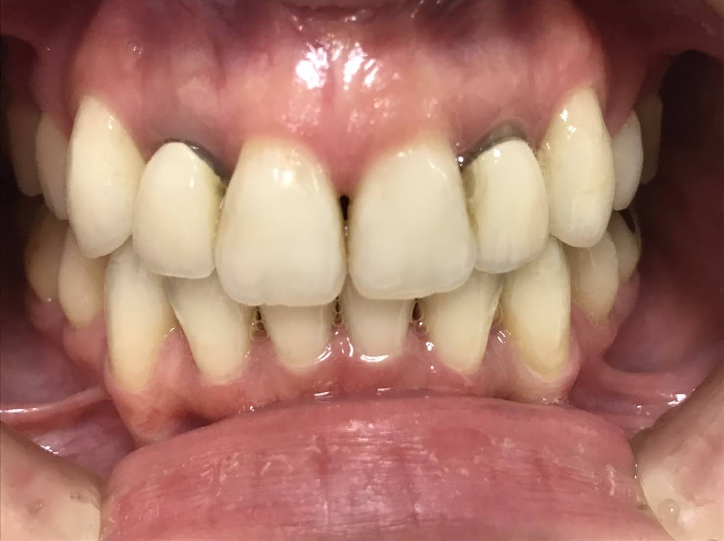 症例１４ セラミッククラウン（2本）施術前