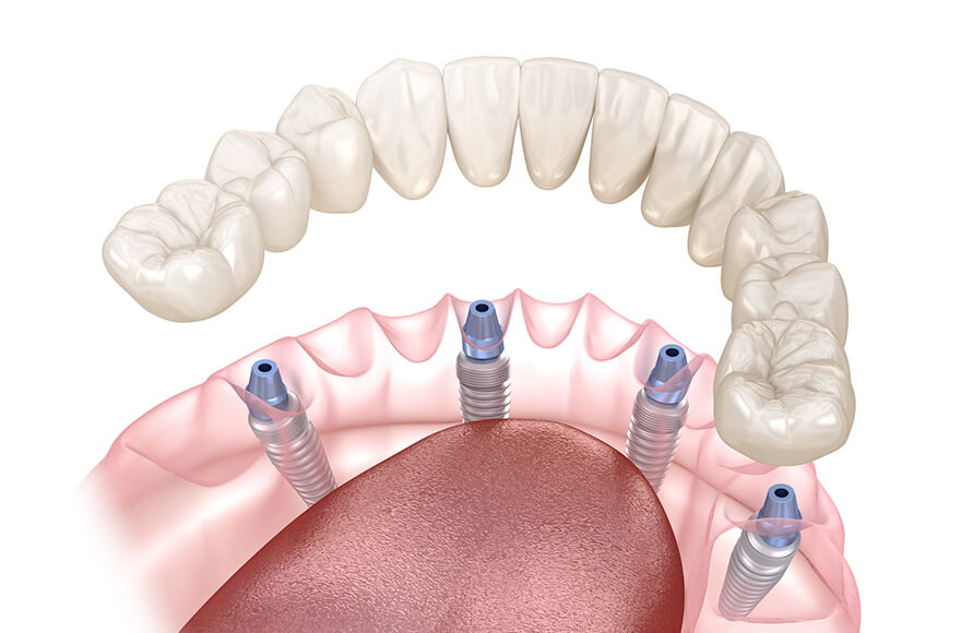 セラミック治療