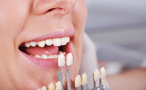 ラミネートベニア