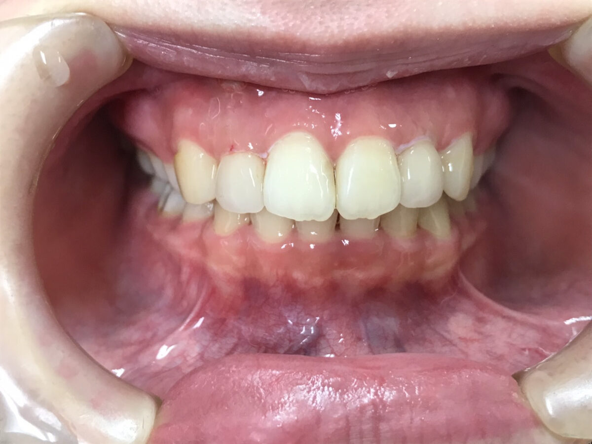 ケース1の治療後