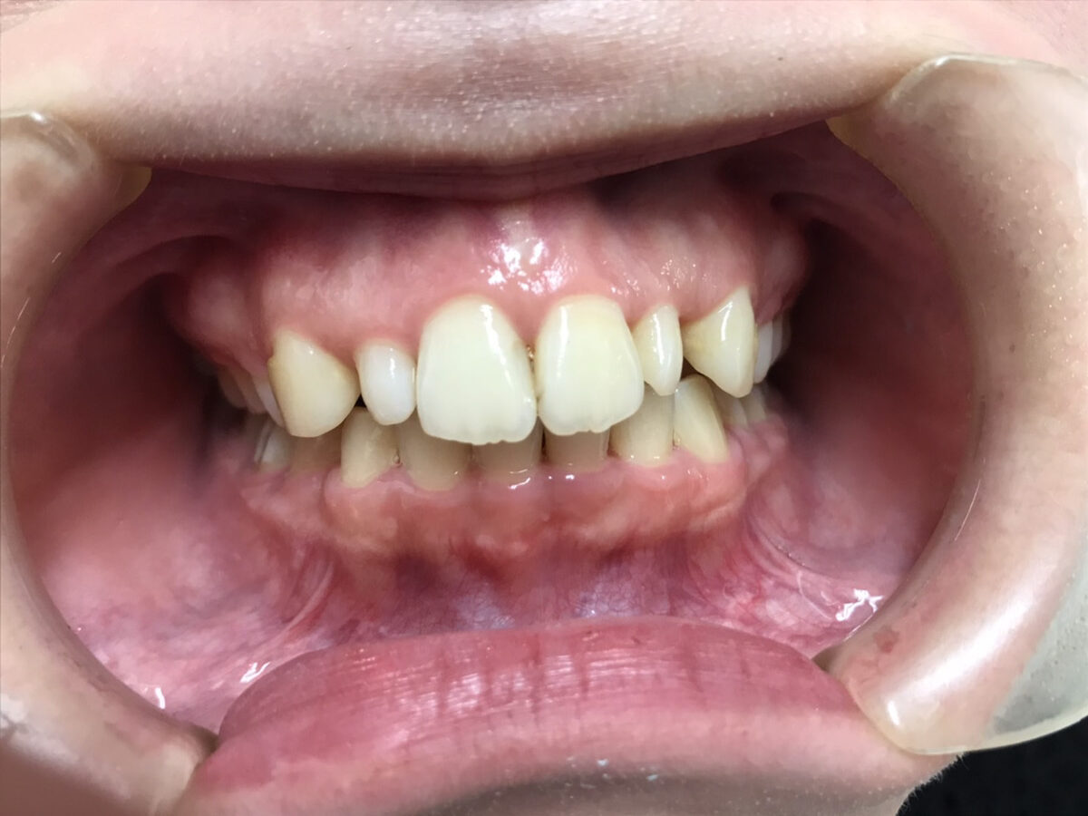 ケース1の治療前