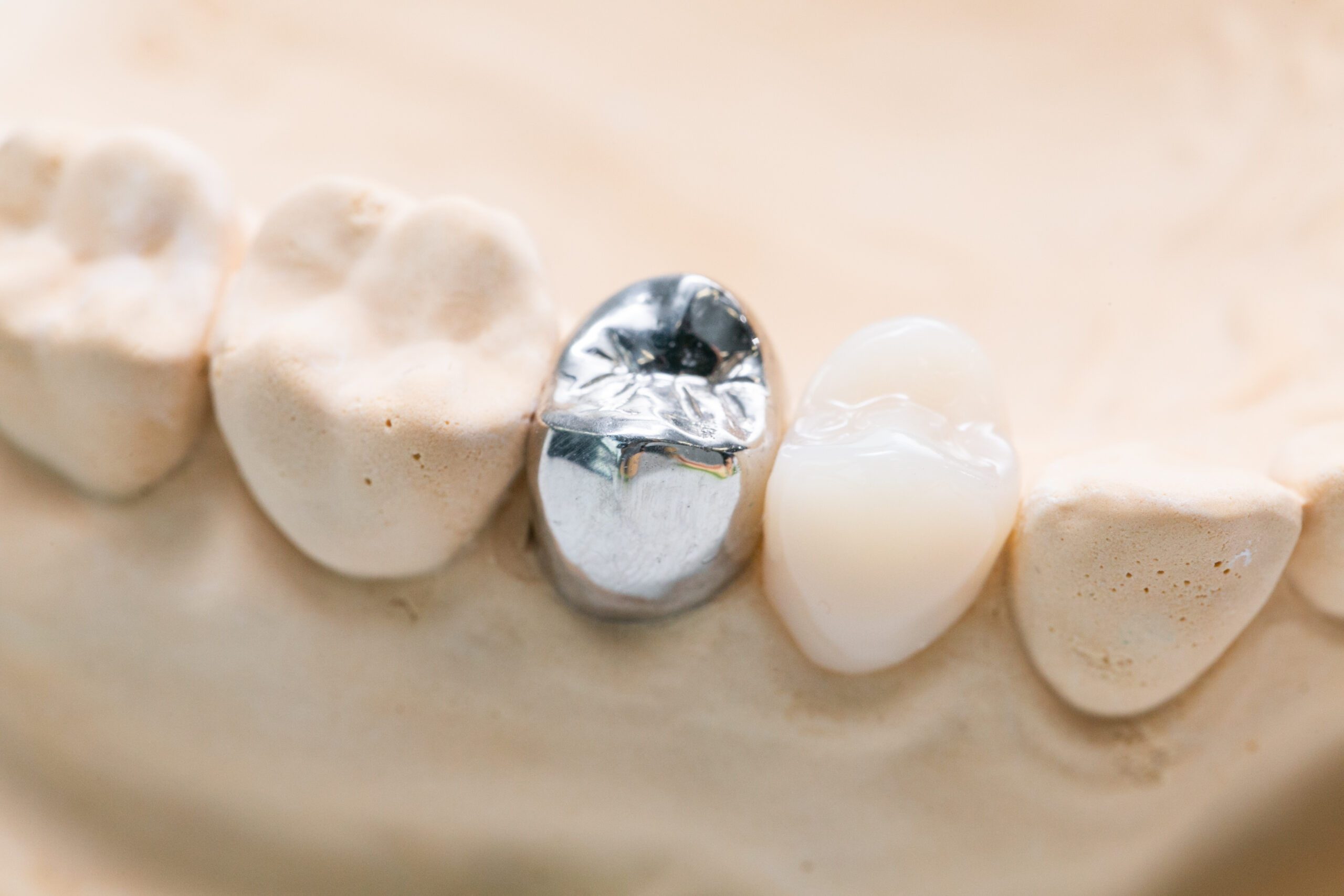 メタルクラウン（銀歯）