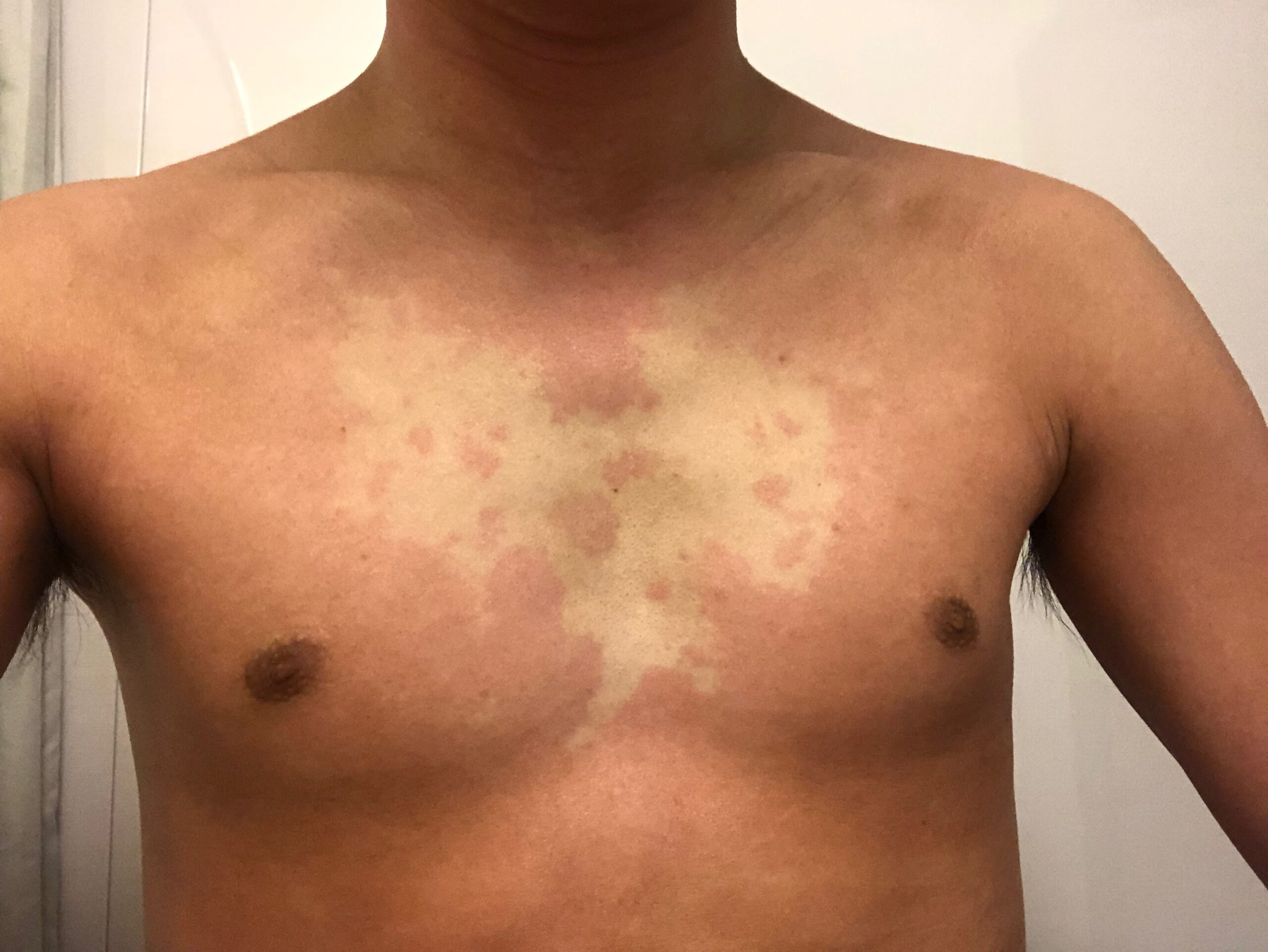 金属アレルギー