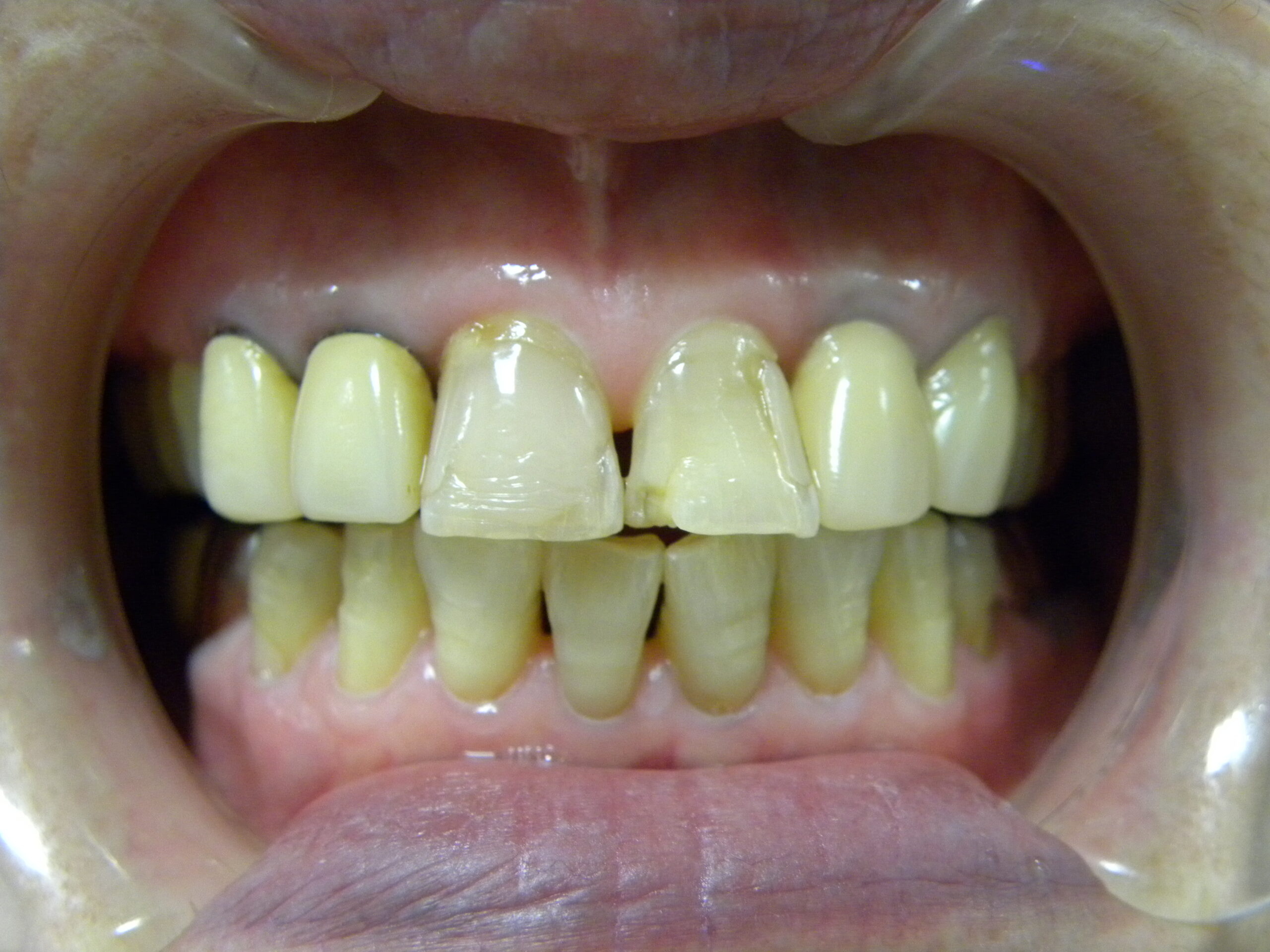 メタルタトゥー