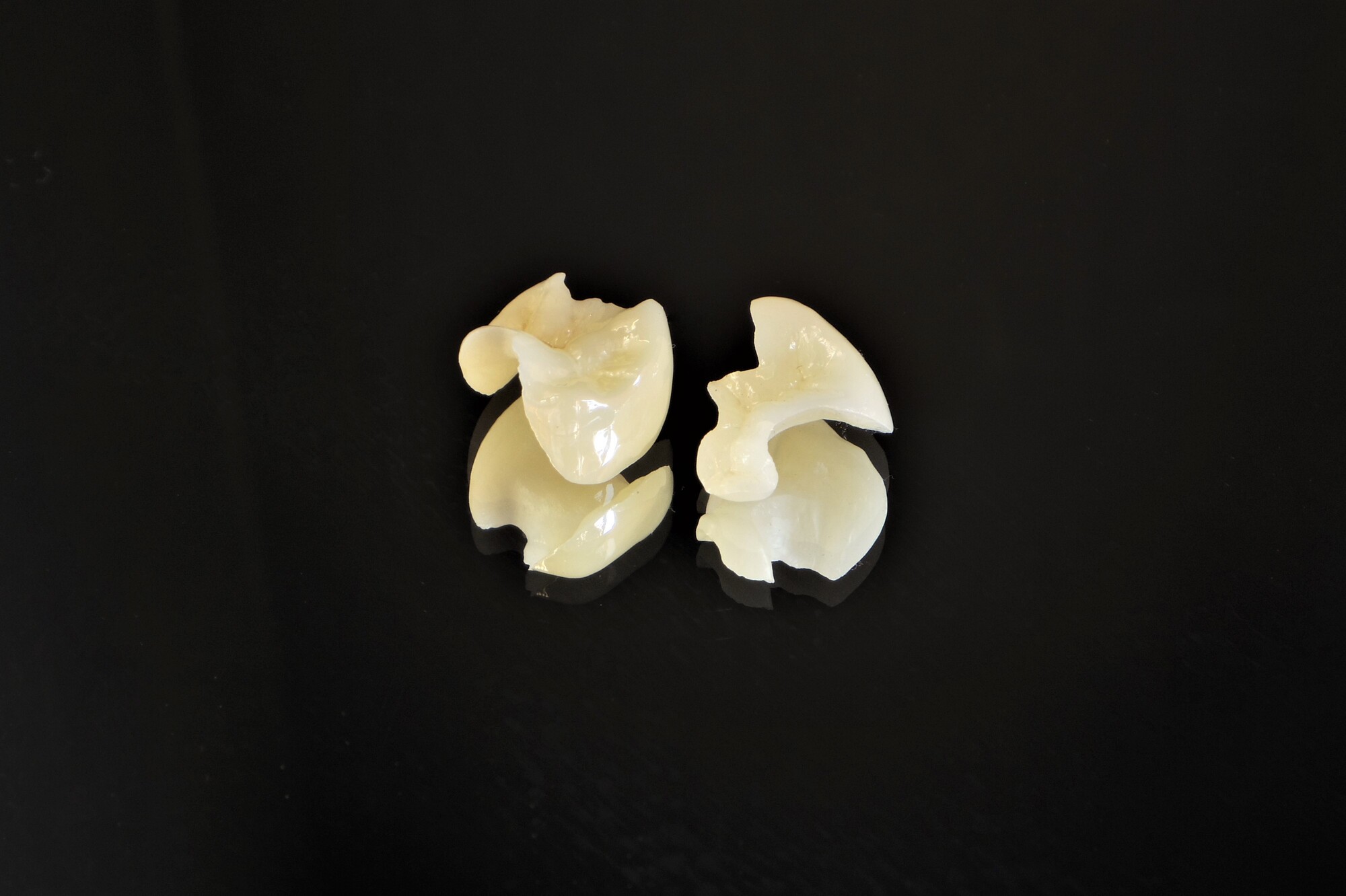 ハイブリッドセラミックインレー